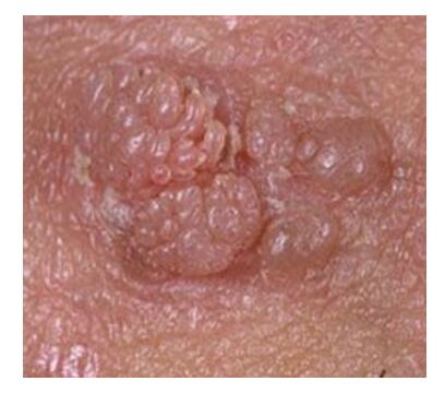 humán papilloma vírus nas l bulas r női genitális papilloma tünetei